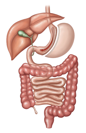 Schlauchmagen (Sleevegastrektomie)