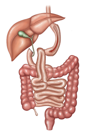 SADI-S (single anastomosis duodeno-ileal bypass with sleeve gastrectomy)