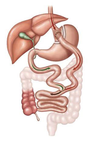 Magenbypass (Roux-Y-Magenbypass)